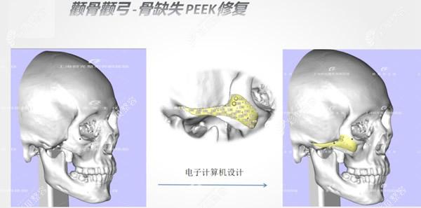 peek人工骨修复颧骨颧弓缺失前后对比照片