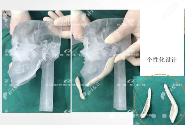peek人工骨修复下颌角前后对比照片