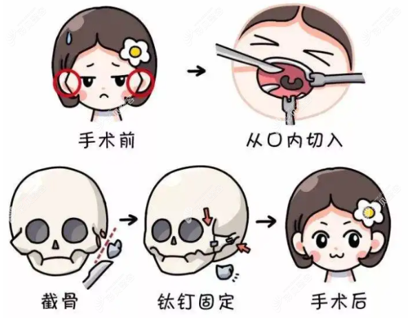 李安平医生做颧骨颧弓磨骨整形好吗