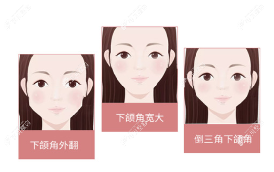 李安平医生做下颌角截骨怎么样