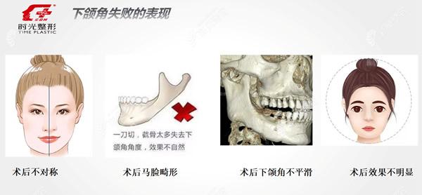 下颌角磨骨手术失败图片及修复方法:补骨,削骨症状要分清