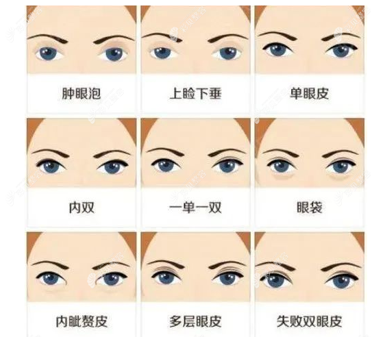 陈志鹏医生做双眼皮怎么样