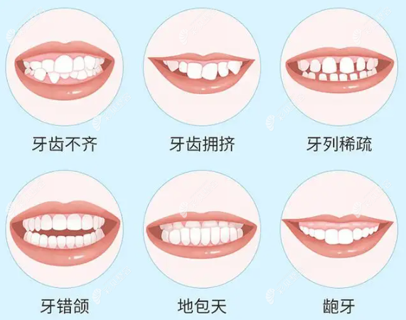 二次矫正比第1次更贵吗？那二次正畸的费用谁来承担？