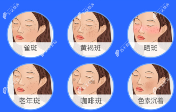 激光祛斑优缺点及适应人群解析