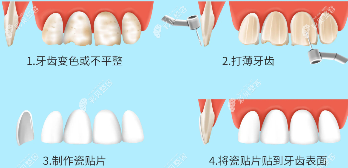 牙齿瓷贴面制作过程图片