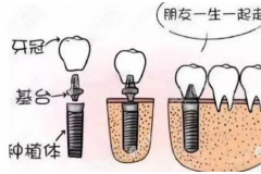 2022上海牙科收费标准,上海种植牙/牙齿矫正等项目价格公示