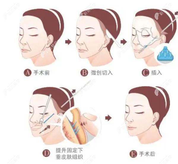 小切口拉皮手术过程和操作步骤图解