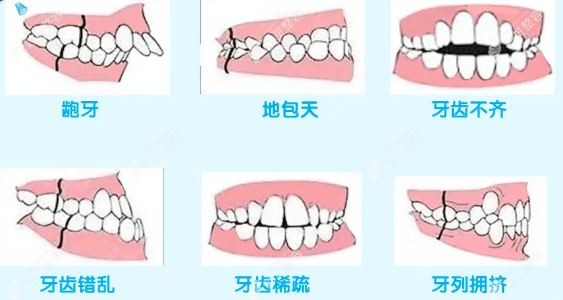 什么样的牙齿需要矫正