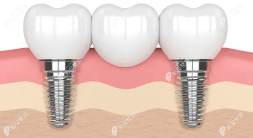 种植牙一期二期三期流程是什么?从开始到结束需要多长时间?