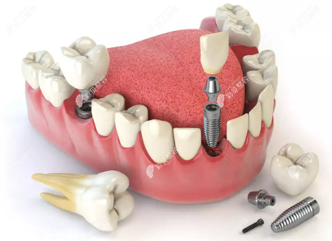 种植牙从开始到结束需要多长时间www.cbzr.com 种植牙从开始到结束需要多长时间www.cbzr.com