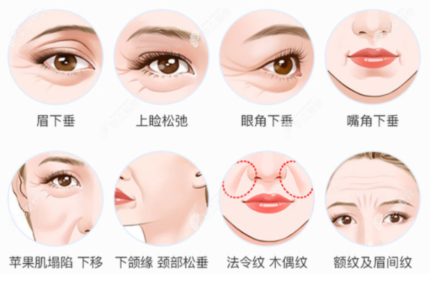 南宁华美徐鸿斌医生做面部除皱好吗