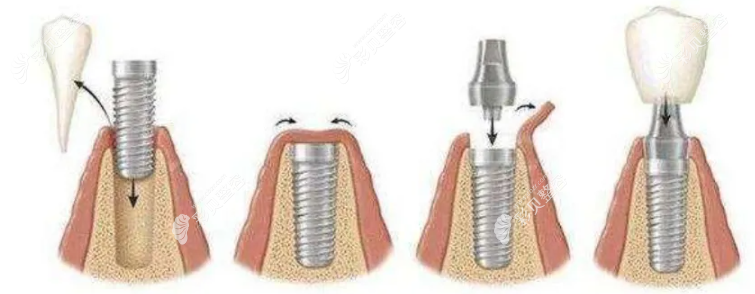 种植牙手术步骤 种植牙手术步骤