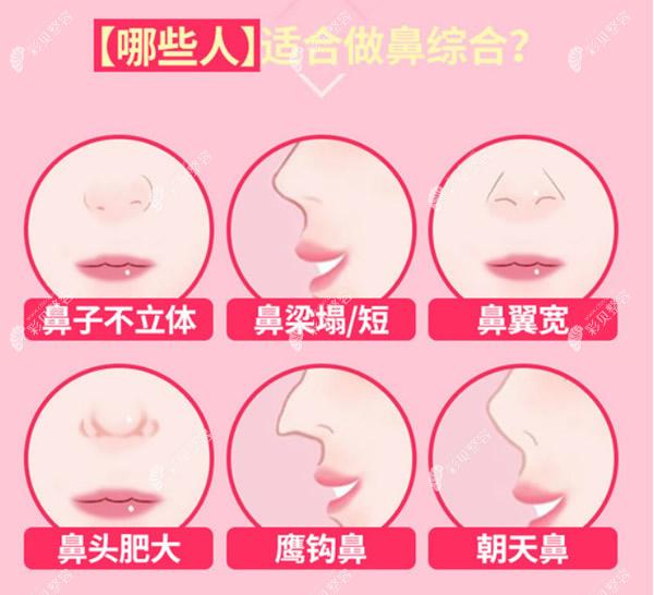 冯雁平医生图片科普哪些人适合做鼻综合
