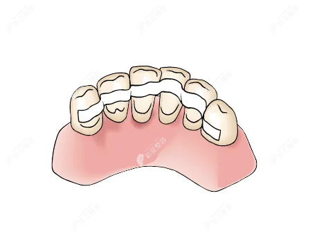 牙周固定术是怎么做的