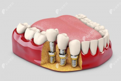 种植牙是纯钛还是钛合金,两种材料都有但纯钛植体种牙好点