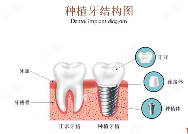 种植牙由几部分组成