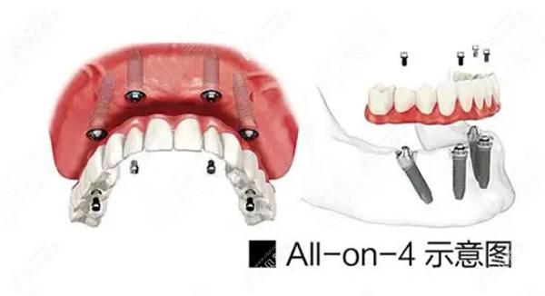 all-on-4半口种植牙示意图