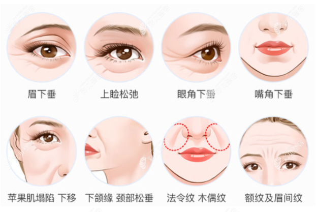 面部拉皮能改善哪些症状 面部拉皮能改善哪些症状