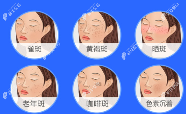 超皮秒可以改善哪些色斑问题