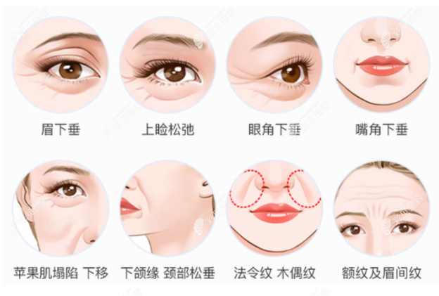 徐阳医生做面部电波拉皮除皱怎么样