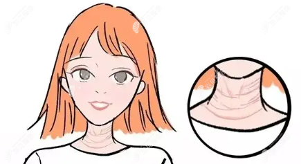 颈纹一旦形成能去掉吗？