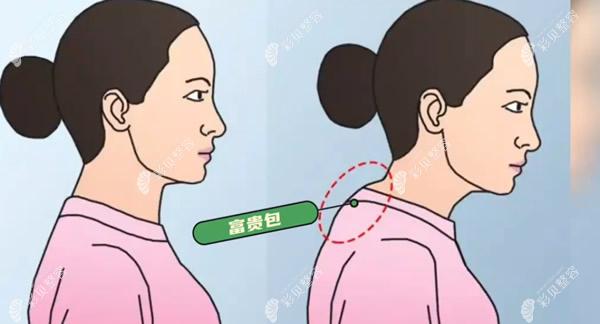 重庆富贵包手术哪个医院做的好?重庆华美/军科/军美排名前3