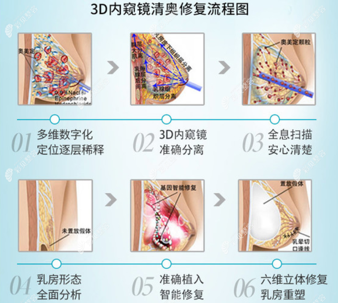 黄广香医生做胸部奥美定取出修复手术靠谱吗