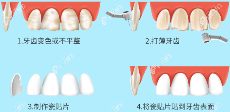 牙贴面修复制作过程图解
