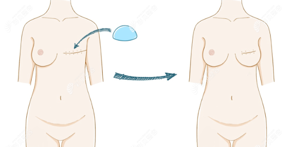 胸假体乳房重建手术优缺点