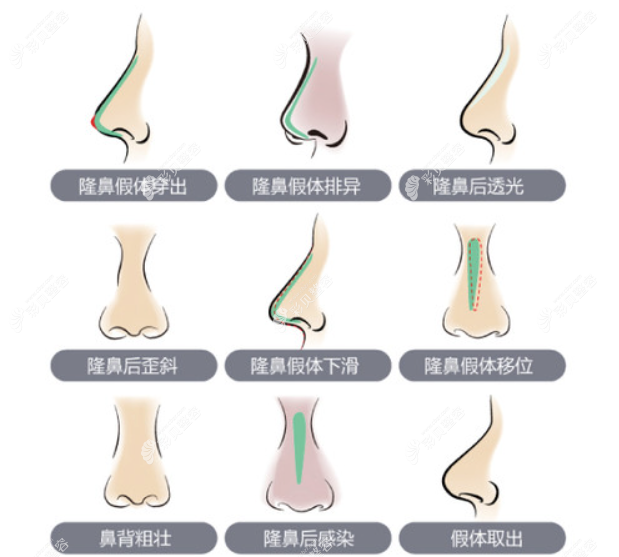 鼻整形失败修复症状有哪些