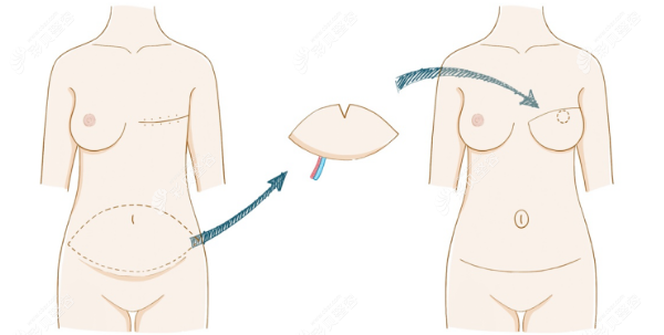 横行腹直肌肌皮瓣胸再造过程图