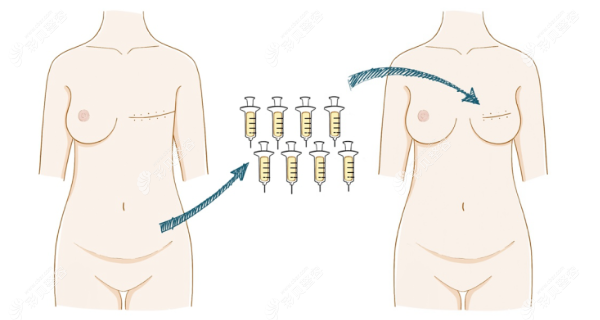 自体脂肪胸再造优缺点介绍