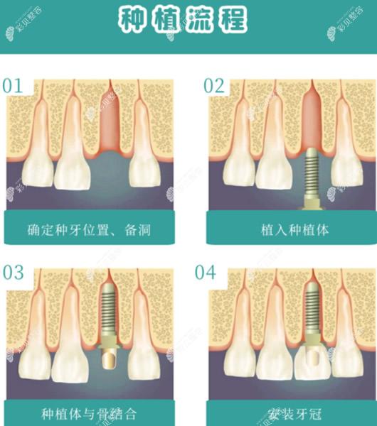 种植牙过程和操作步骤