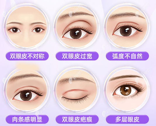 合肥韩美做双眼皮修复怎么样,韩美做眼修复技术靠谱价格低