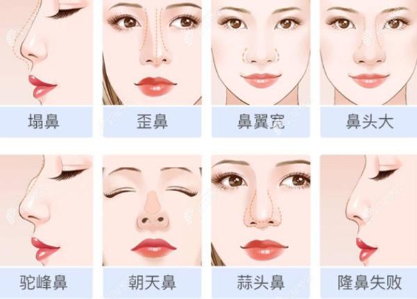 北京沃尔医院赵丹医生做鼻子怎么样