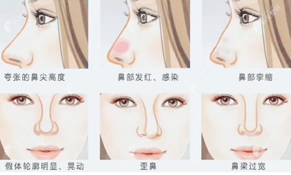 北京沃尔刘彦军鼻修复怎么样