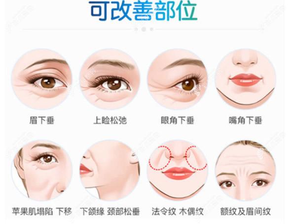 面部拉皮手术适合哪些部位