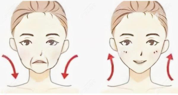 面部拉皮手术前后对比照片