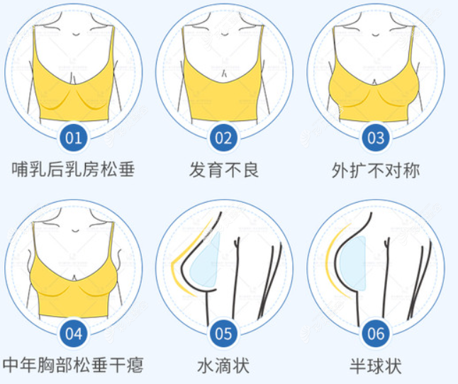 南京美莱假体隆胸多少钱一次