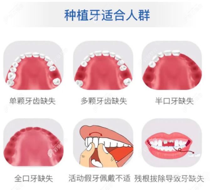 漳州仰德医院种植牙科普