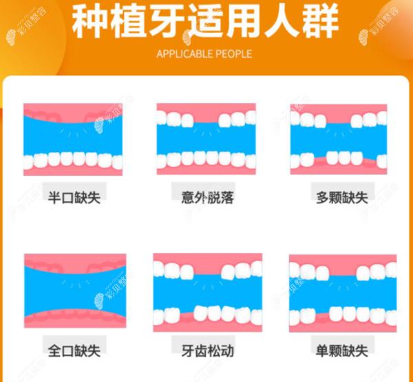 泉州盛安口腔种植牙怎么样