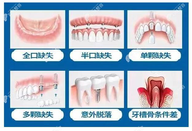 吴兴隆医生种牙技术怎么样