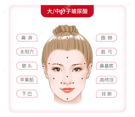 南京美莱打玻尿酸怎么样www.cbzr.com