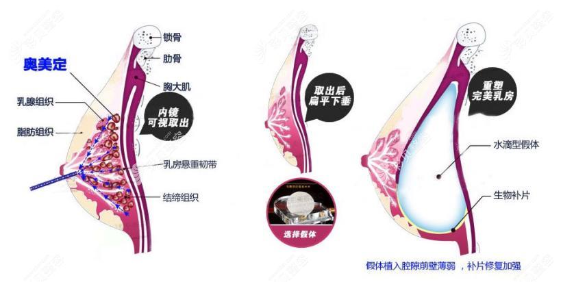 黄广香做胸部奥美定取出技术怎么样