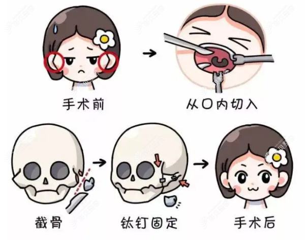 颧骨内推手术过程图解