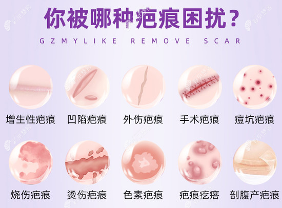 激光祛疤能淡化到几乎看不见吗www.cbzr.com