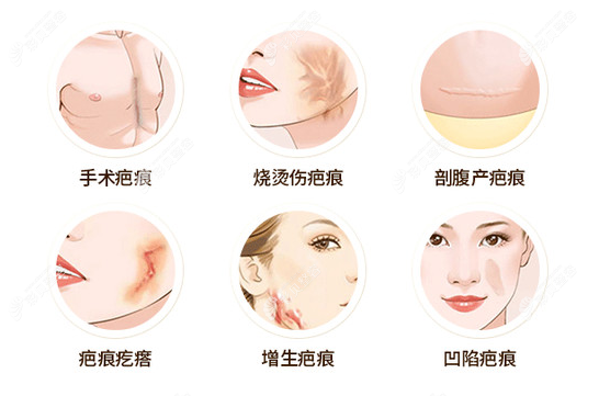 激光祛疤一般多少钱