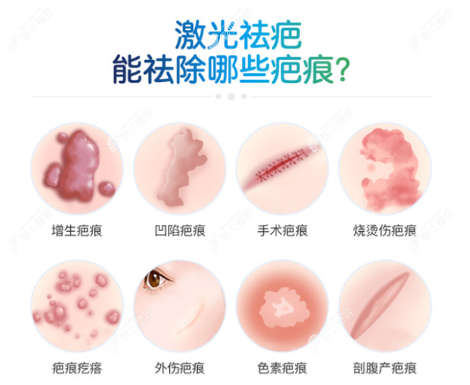 烧伤后的新疤痕多久做激光好,激光能淡化到几乎看不见吗？