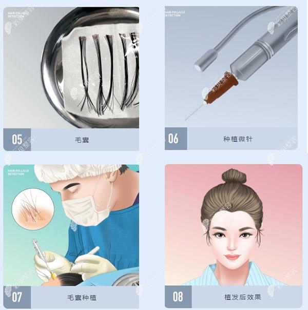 不剃发植发操作过程和步骤