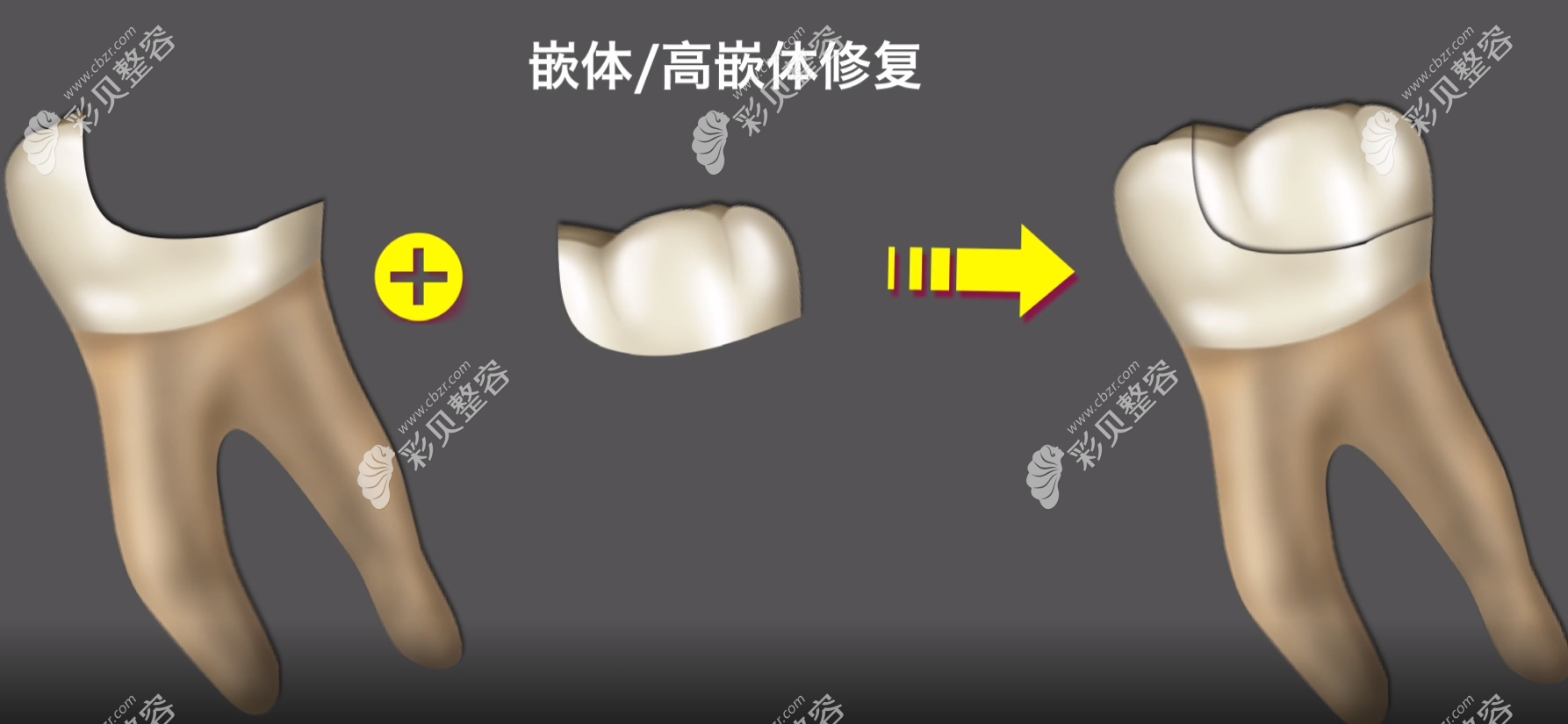 嵌体补牙过程图解